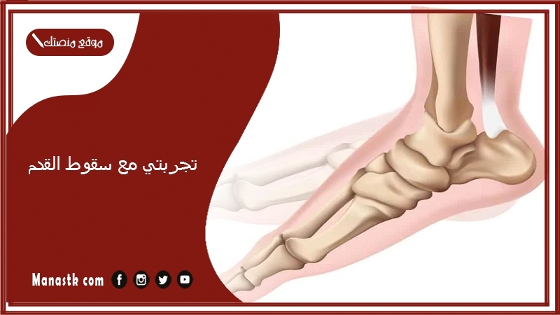 تجربتي مع سقوط القدم.. أضرار سقوط القدم