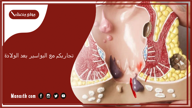 تجاربكم مع البواسير بعد الولادة.. كيفية التخلص من البواسير بعد الولادة وهل يكون في تدخل جراحي