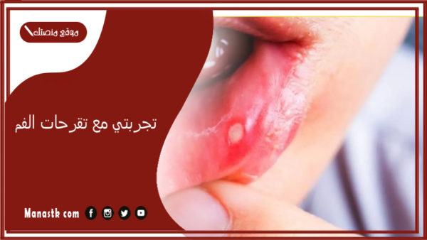 تجربتي مع تقرحات الفم.. علاج نهائي لتقرحات الفم