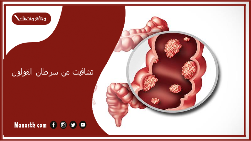 تشافيت من سرطان القولون.. هل يمكن الشفاء نهائيا من سرطان القولون؟