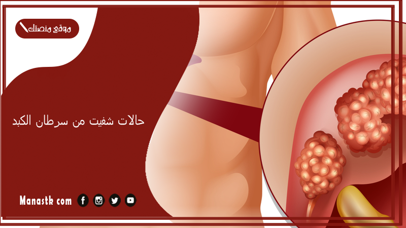 حالات شفيت من سرطان الكبد.. تجربتي مع سرطان الكبد