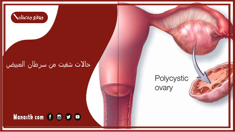 حالات شفيت من سرطان المبيض.. قصتي مع سرطان المبيض