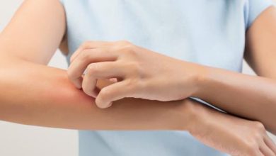 علاج الأرتيكاريا بالأعشاب