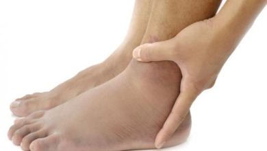 علاج تورم الساقين بالأعشاب