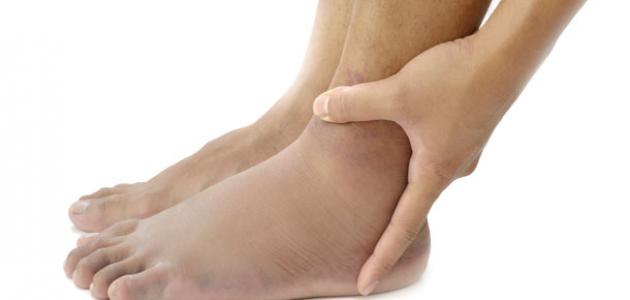 ما هي طرق علاج تورم الساقين بالأعشاب