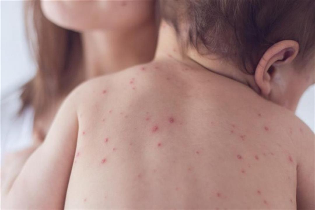 ما هي أهمية التطعيم ضد الحصبة الألمانية .. كيفية إعطاء مطعوم الحصبة الألمانية
