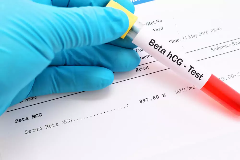 ما هو تحليل B-HCG؟ وكيف يتم وما وظيفته؟