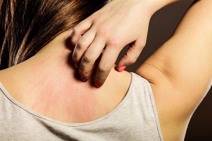ما هي أفضل وصفات علاج الحكة والجرب بالأعشاب الطبيعية في المنزل