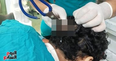 فريق جراحي بالتأمين الصحي ببنها ينقذ حياة مريض بإزالة مقص