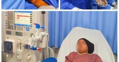 نجاح أول عملية غسيل كلوي في طوارئ أطفال مستشفى دسوق